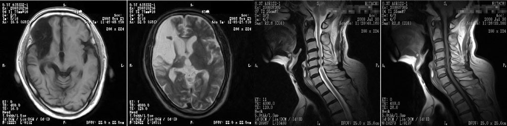 MRI_症例画像
